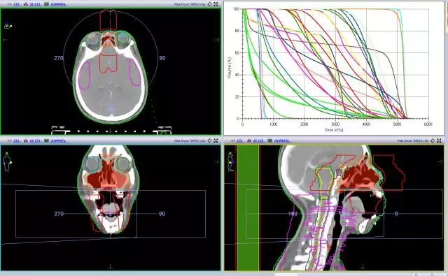 2.1 优化完毕横断面,冠状面,矢状面剂量分布及 dvh