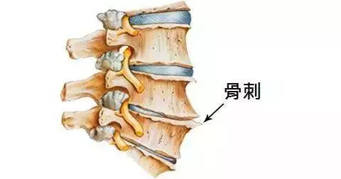 骨刺怎么办