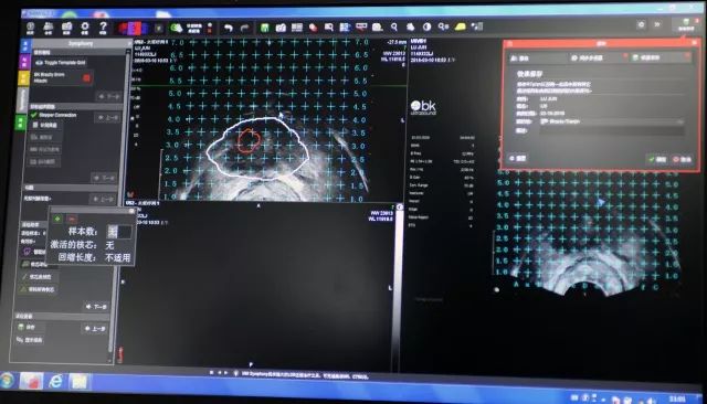 中大医院泌尿外科使用最新一代超声融合多参数磁共振经会阴前列腺靶向