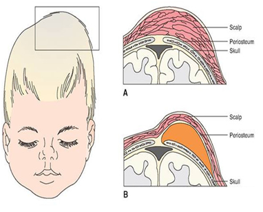 新生儿会出现的三种头颅问题!