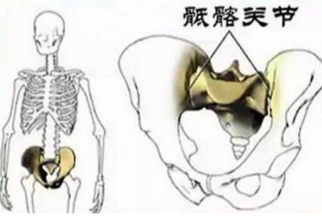 腰骶关节错位,腰椎间盘突出症并发骨盆旋移症者.