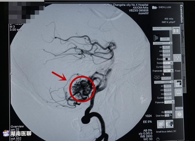 老人头晕乏力,一查:右小脑血管畸形"乱如麻!