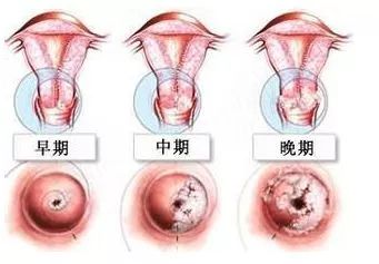 【科普】做阴道镜检查预示着得了宫颈癌吗?