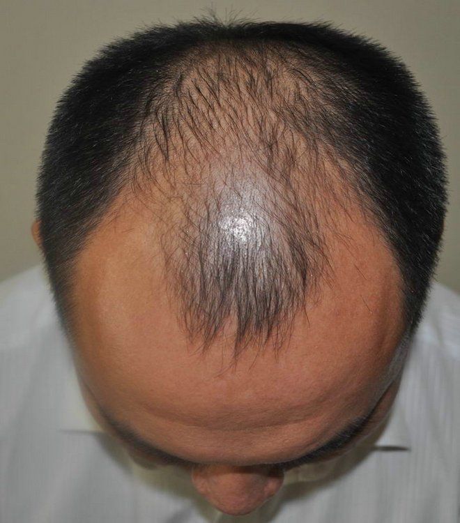 头皮专家黄超~~论脂溢性脱发的症状,病发原因和类型