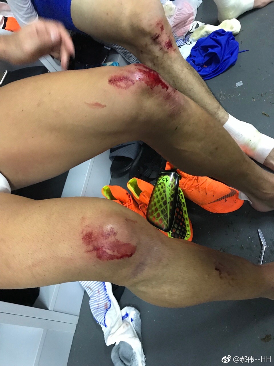 赛后,鲁能教练郝伟在网上发布了球员受伤照片.