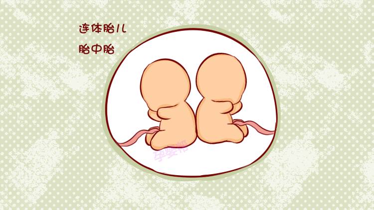 2,若是小胎儿寄生在大胎儿体内,这种情况则会形成"胎中胎.