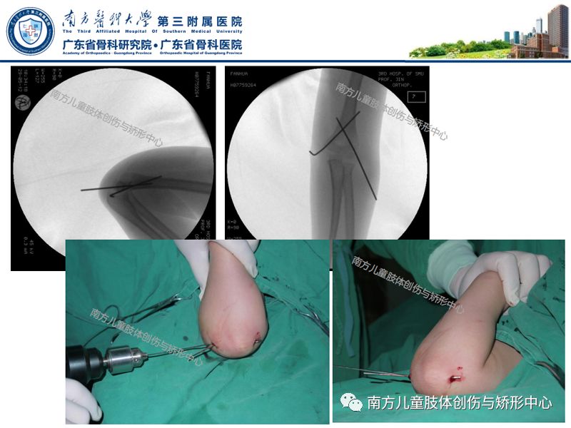 第2期:小儿肱骨髁上骨折的治疗策略