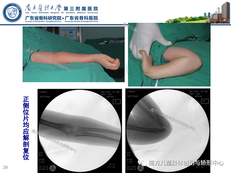 第2期:小儿肱骨髁上骨折的治疗策略