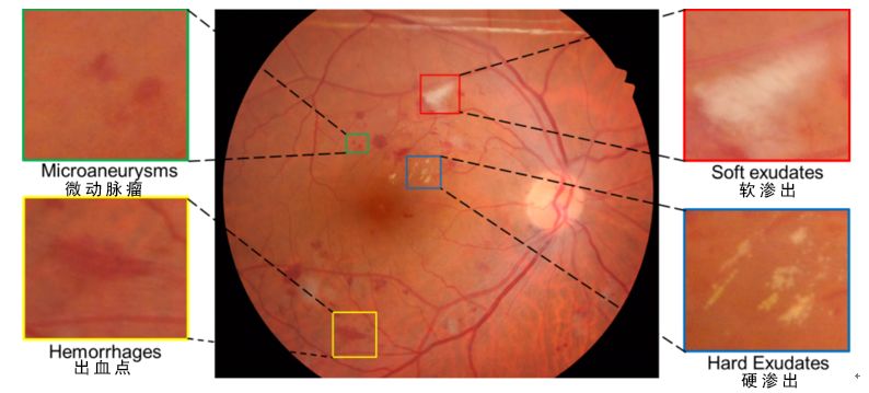科大讯飞医学影像再下一城 夺得眼底图分析国际赛事冠军