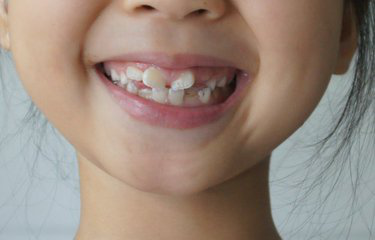 儿童牙齿不整齐需要矫正吗
