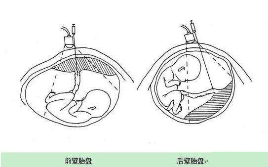 怀孕时,胎盘的前壁和后壁有什么不一样?