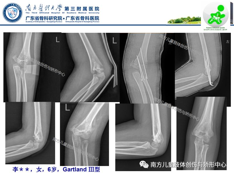 第2期:小儿肱骨髁上骨折的治疗策略