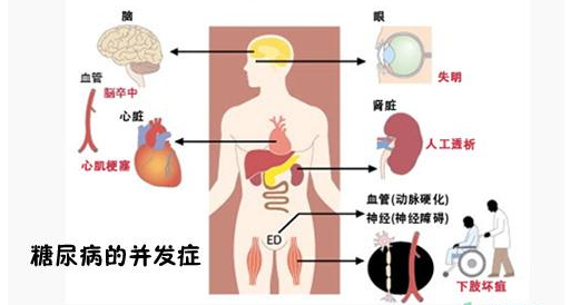 而更可怕的是糖尿病并发症,其中慢性并发症有:视网膜病变,糖尿病足