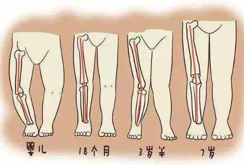 则变成了直腿; ● 3至6岁时,腿型开始出现膝外翻,看上去就像"x型腿"