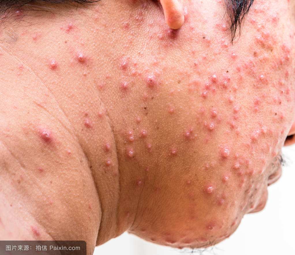 当炎性再严重点,可能就不是很一样了,如下图: 丘疹属于痤疮最基本的