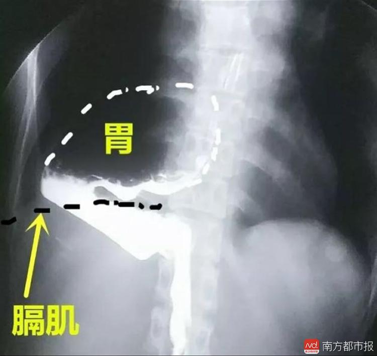 x光显示陈女士的胃体已进入右侧胸腔