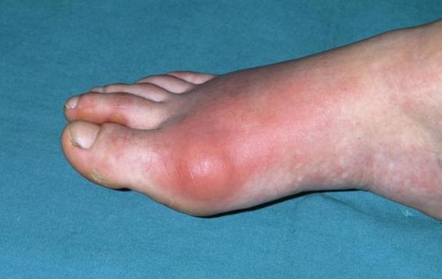 脚上出现3大症状,痛风无疑,需要溶解尿酸控制痛风恶化