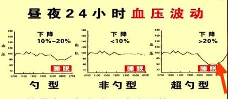 非勺型血压是指夜间平均血压与白天血压比较降幅小,通常在10 mmhg以下