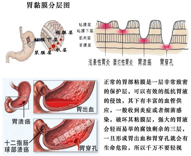 皮质激素,洋地黄,消炎痛,保泰松等,可引起慢性胃粘膜损害