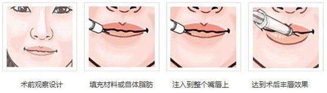 吕晓杰:如何拥有一个勾魂摄魄的微笑唇?