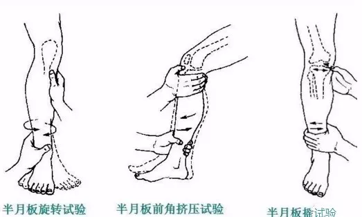 半月板损伤怎么做恢复运动?