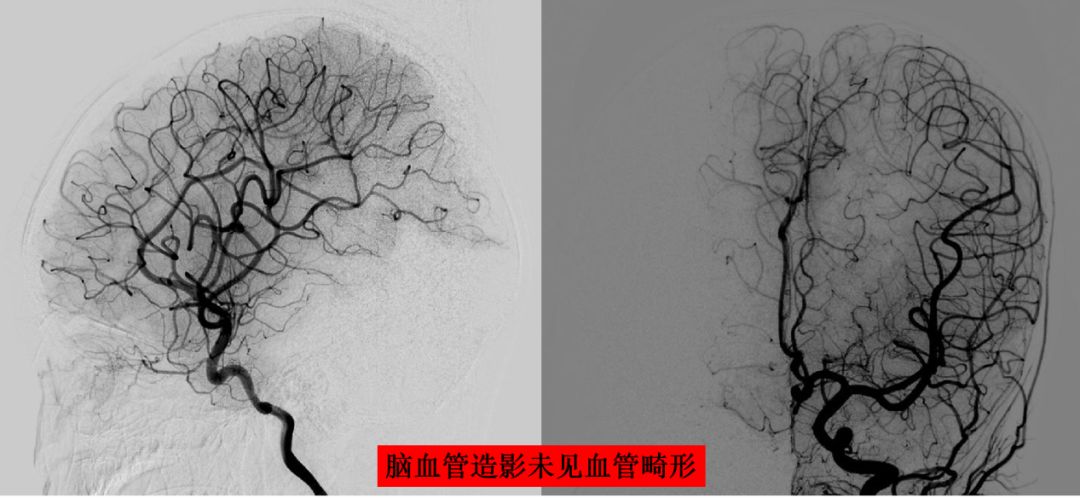 【儿医技术】脑血管造影——一项检查避免了一次开颅手术