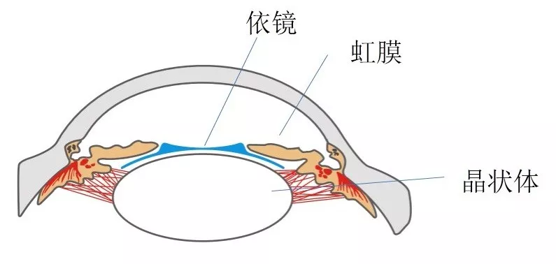 phakic refractive lens,是一款矫正近视的有晶体眼后房屈光晶体