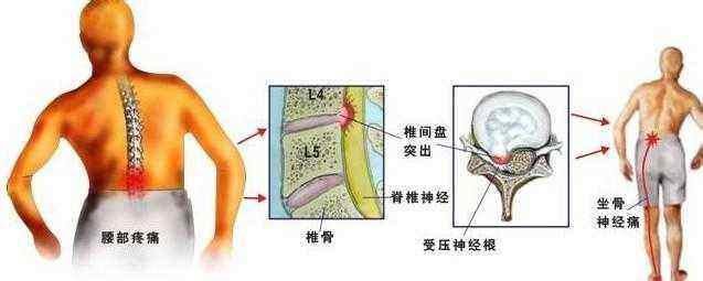 坐骨神经痛的中医针灸疗法