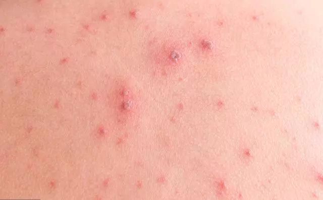 其实肝癌早期出现皮肤瘙痒,是预示着病情已经开始严重起来了.