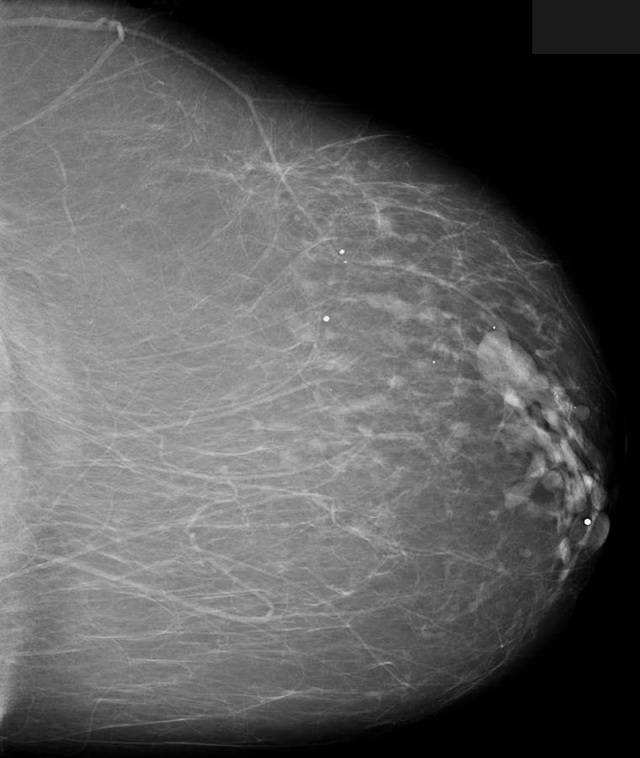 乳房检出钙化灶,是得了乳腺癌?
