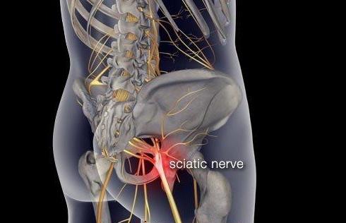 【坐骨神经痛】引起骨盆侧倾或腰椎侧弯的其他情况:单肩背包如果你的