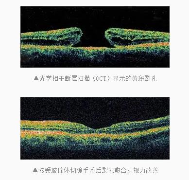 第四期,病人视力多已受到较大的破坏,即使手术后裂孔封闭,视力恢复也