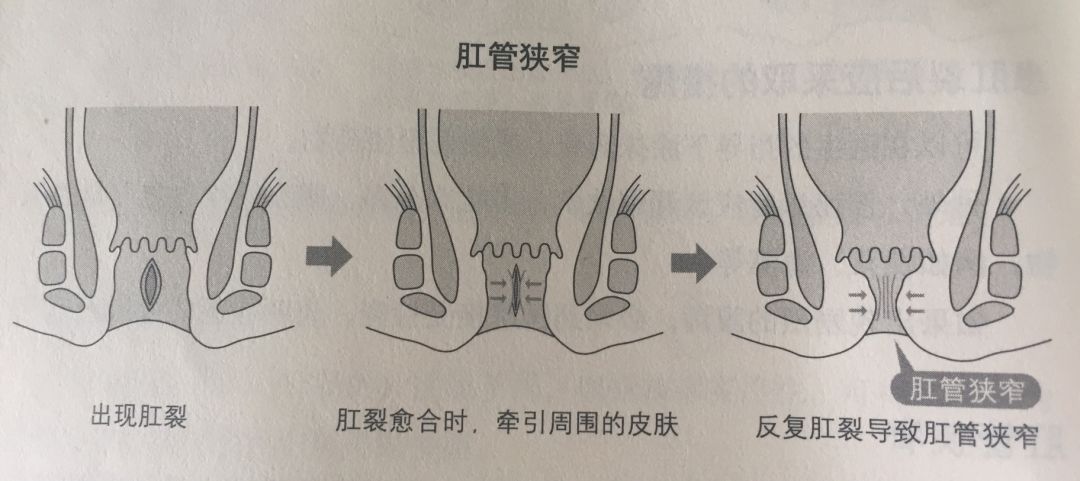 早期肛裂(急性期):裂口新鲜, 疼痛较轻,肛门括约肌尚未受到伤害,通常