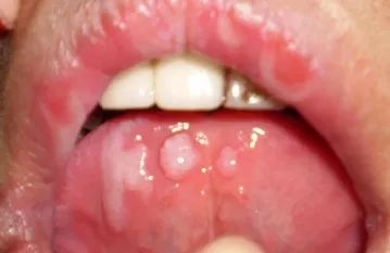 尤其是口腔黏膜变粗糙,变厚或呈硬结,出现口腔黏膜白斑,红斑