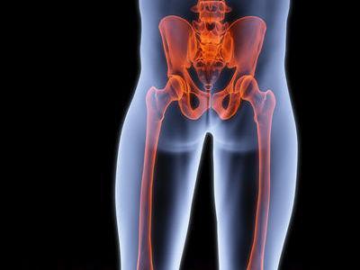 【专家解析】股骨头坏死的患者该不该换关节?