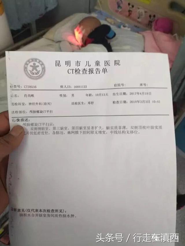 昆明市儿童医院ct检查报告单,诊断意见:脑积水合并脑室旁间质性脑水肿