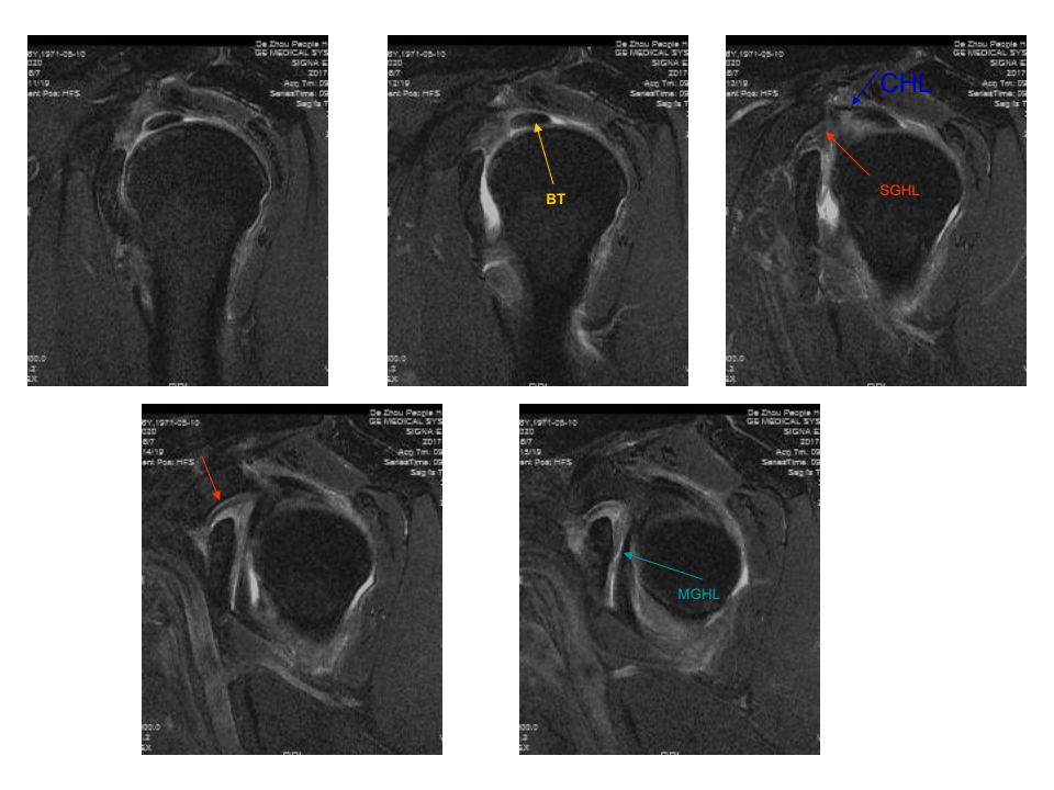 肩关节韧带及损伤mr表现(上)