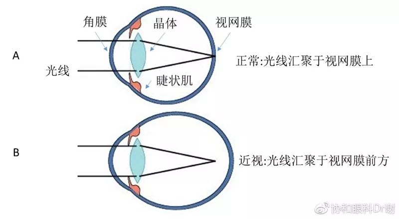 近视矫正手术的原理_从原理讲透彻 东莞全飞秒近视手术的利与弊