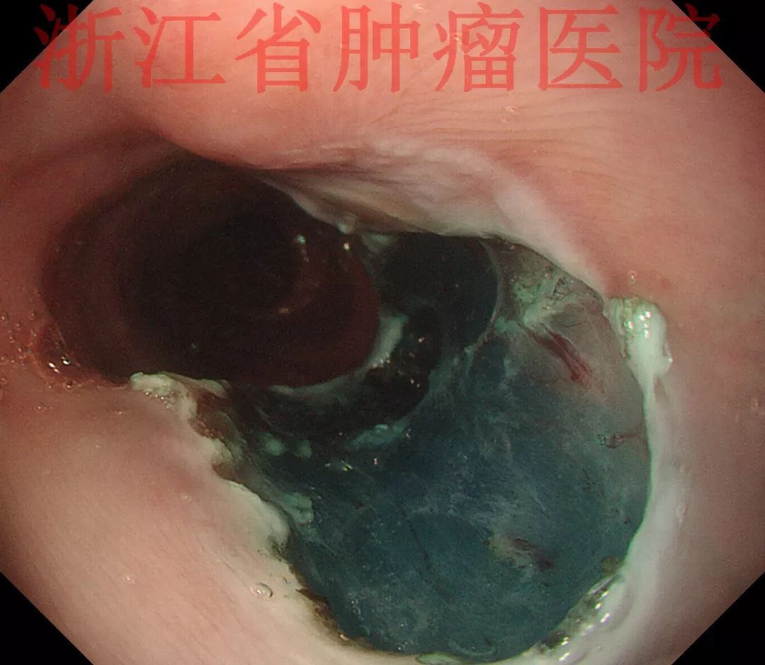 多图解析esd治疗的食管转移性粘液腺癌1例