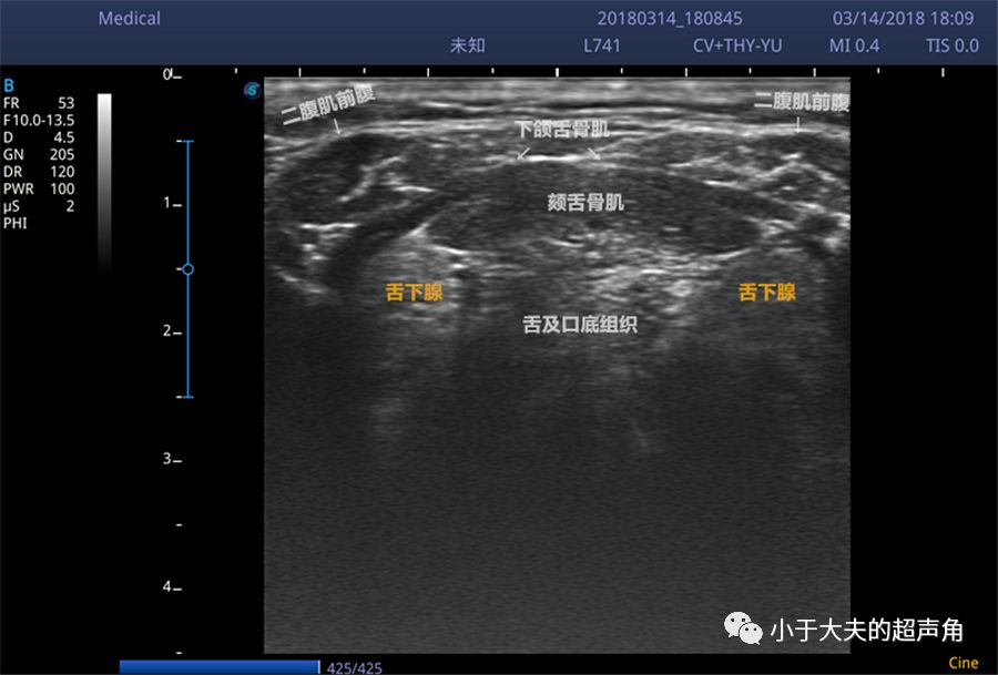 涎腺--舌下腺(sublingualgland)