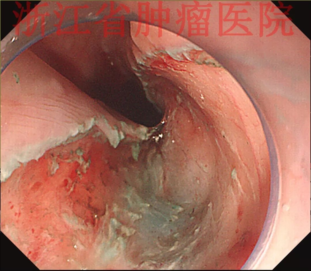 多图解析,esd治疗的食管转移性粘液腺癌1例