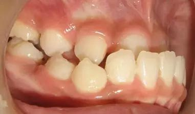 什么是牙颌畸形和正颌外科?