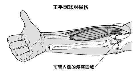 网球肘(肱骨外上髁炎)是指手肘外侧肌腱发炎疼痛.