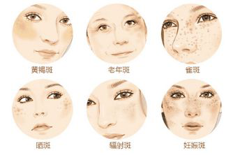 正文  首先,脸上的色斑其实有很多种,例如:黄褐斑,晒斑,妊娠斑,辐射斑