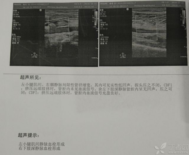 病例分享:典型急性肺栓塞 1 例