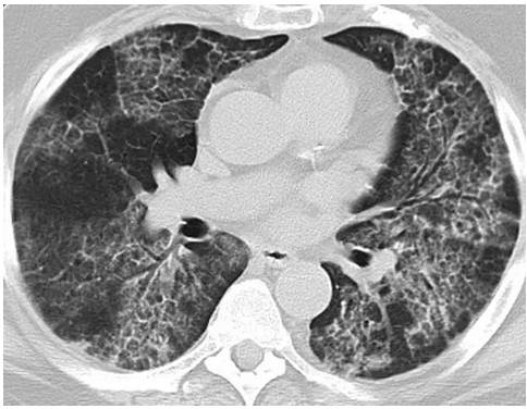 间质性肺炎的临床,组织学,及ct特点