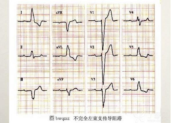 心电图异常怎么办