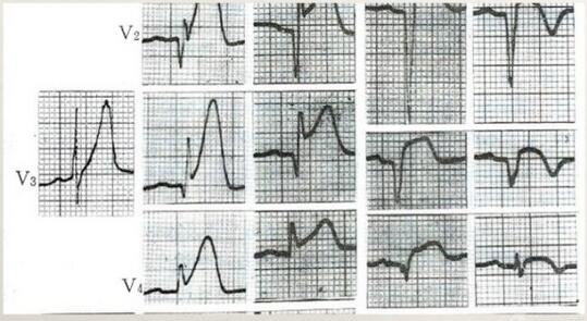 心电图异常怎么办