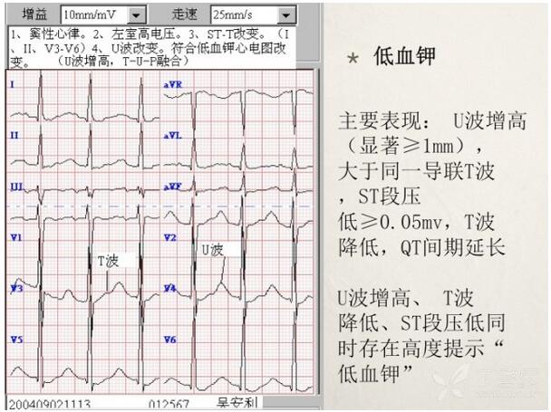 心电图异常怎么办