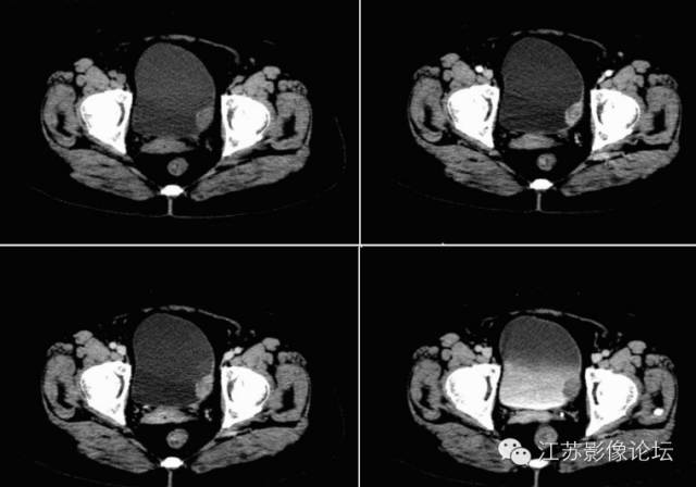 膀胱癌的影像诊断
